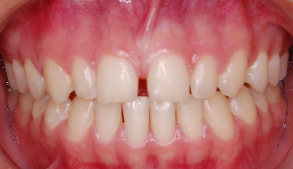 Antes Antes