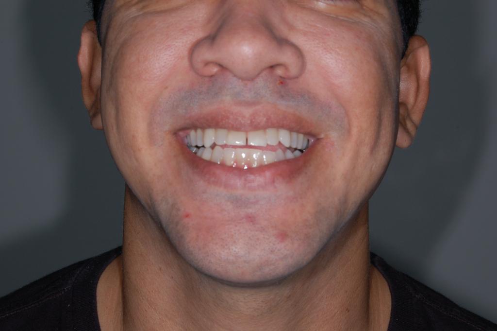 Antes Antes