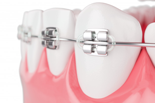 https://www.risoclin.com.br/wp-content/uploads/2020/09/close-up-beauty-health-teeth-with-brace-selective-focus-3d-render_40193-409.jpg