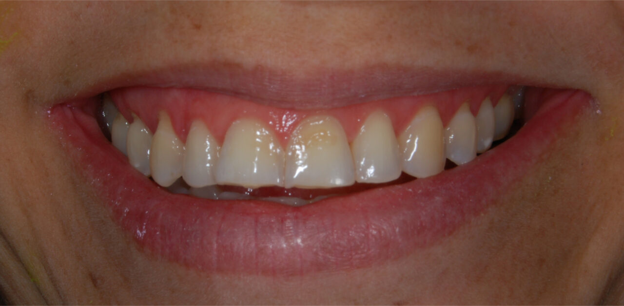 Antes Antes
