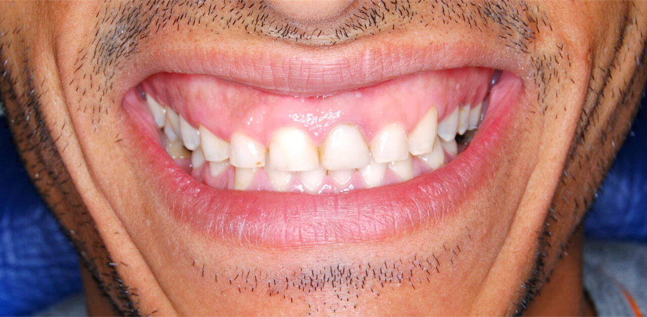 Antes Antes