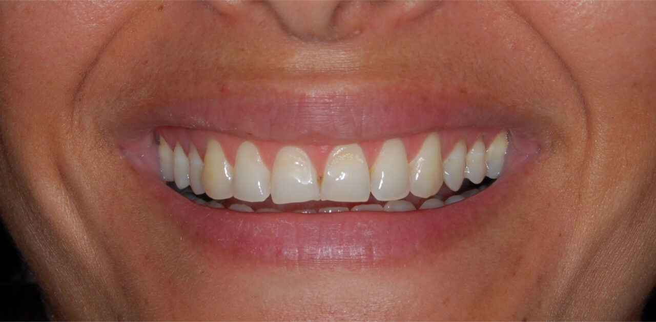 Antes Antes