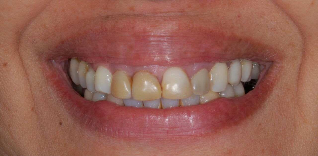 Antes Antes
