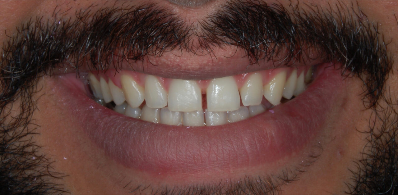 Antes Antes