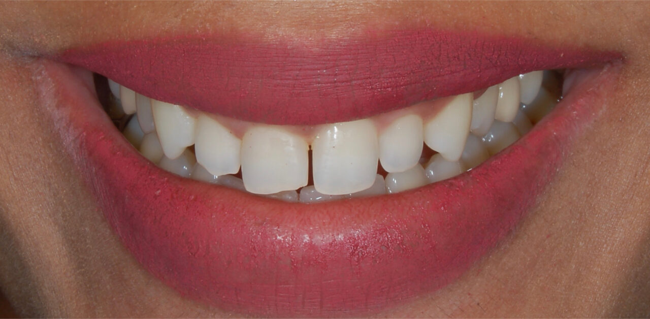 Antes Antes