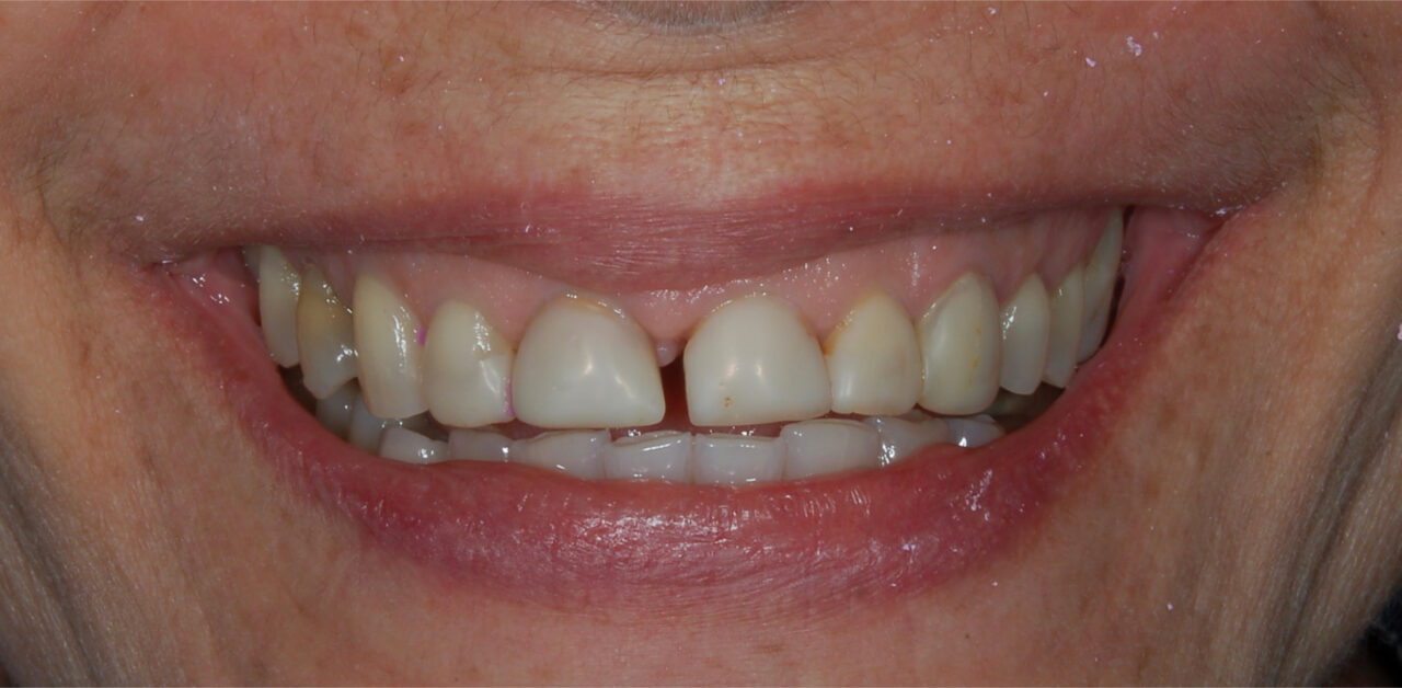 Antes Antes