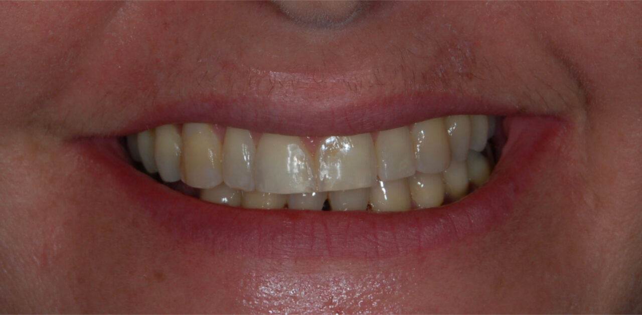 Antes Antes